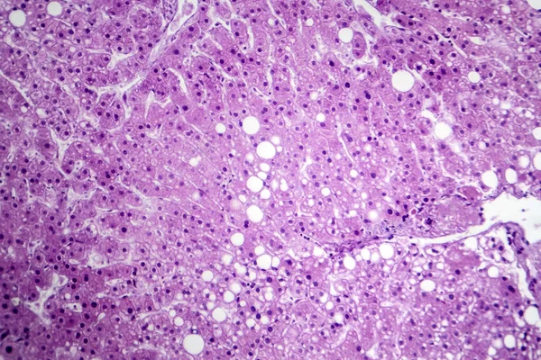 Hepatik Steatozun Fotomikroskobu Yağ Hastalığı Olarak Bilinen Karaciğer Hücrelerinde Yağ — Stok fotoğraf