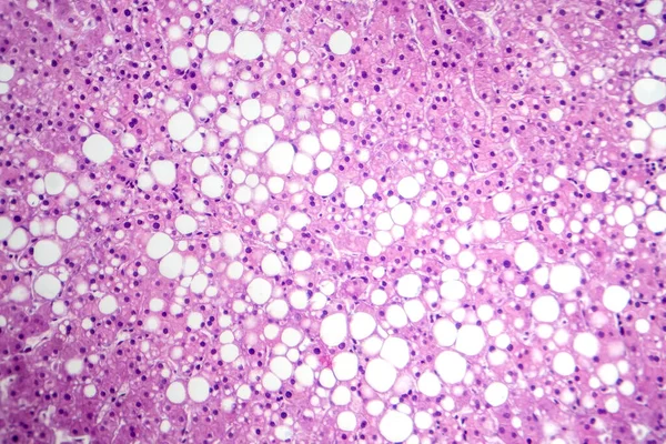 Photomicrograph of hepatic steatosis, revealing fat accumulation in liver cells, known as fatty liver disease.