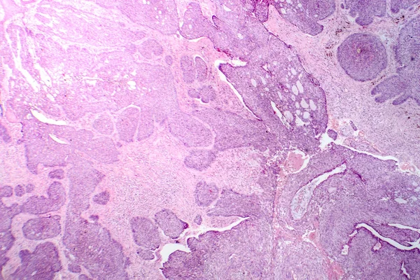 Фотомикрограф Базально Клеточной Карциномы Показывающий Злокачественные Базальные Клетки Типичные Наиболее — стоковое фото