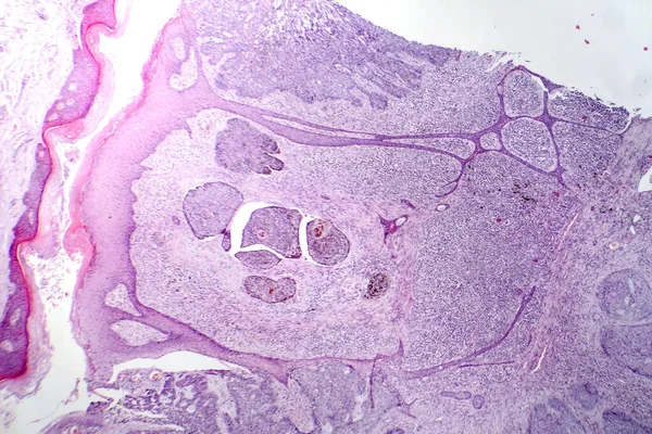 Fotomicrografía Del Carcinoma Basocelular Mostrando Células Basales Malignas Típicas Del — Foto de Stock
