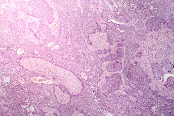 Φωτομικρογραφία Του Βασικοκυτταρικού Καρκινώματος Εμφανίζοντας Κακοήθη Βασικά Κύτταρα Τυπικά Του — Φωτογραφία Αρχείου