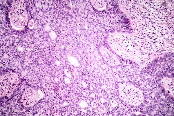 基底细胞癌的显微照片 显示最常见皮肤癌的恶性基底细胞 — 图库照片