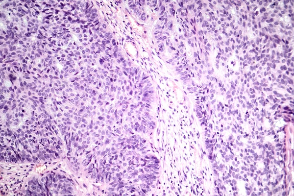 Photomicrograph Basal Cell Carcinoma Displaying Malignant Basal Cells Typical Most — Stock Photo, Image