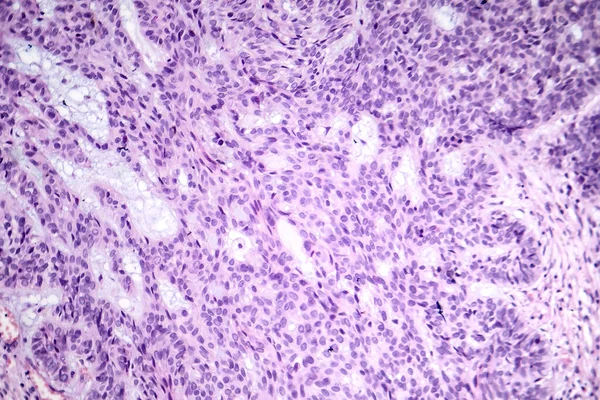 Photomicrograph of basal cell carcinoma, displaying malignant basal cells typical of the most common skin cancer.