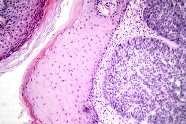 Φωτομικρογραφία Του Βασικοκυτταρικού Καρκινώματος Εμφανίζοντας Κακοήθη Βασικά Κύτταρα Τυπικά Του — Φωτογραφία Αρχείου