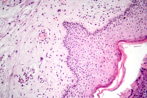 基底细胞癌的显微照片 显示最常见皮肤癌的恶性基底细胞 — 图库照片