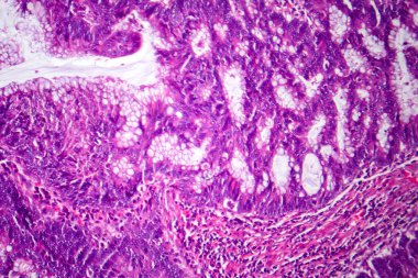 Photomicrograph of colon adenocarcinoma, illustrating malignant glandular cells characteristic of colon cancer. clipart