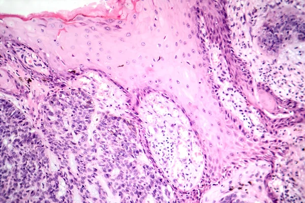 Fotomikrograf Bazocelulárního Karcinomu Zobrazující Maligní Bazální Buňky Typické Pro Nejčastější — Stock fotografie
