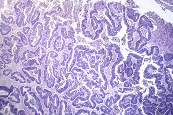 Nyelőcső Squamosus Sejtes Carcinomájának Fotomikrográfja Rosszindulatú Laphámsejteket Mutat Amelyek Nyelőcsőrákra — Stock Fotó