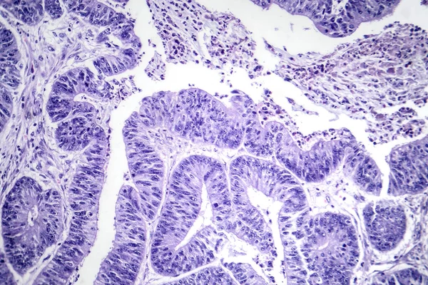 Fotomicrogramma Del Carcinoma Esofageo Cellule Squamose Che Mostra Cellule Squamose — Foto Stock
