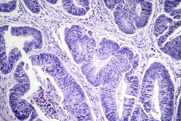 Photomicrograph Esophageal Squamous Cell Carcinoma Showing Malignant Squamous Cells Characteristic — Stock Photo, Image