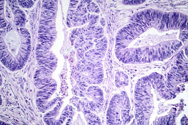 Fotomikrograf Dlaždicobuněčného Karcinomu Jícnu Ukazující Zhoubné Dlaždicové Buňky Charakteristické Pro — Stock fotografie