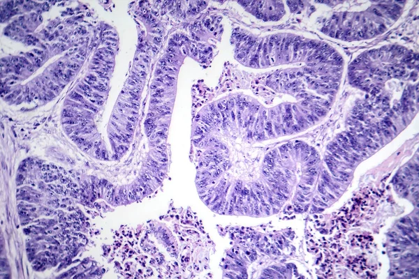 Photomicrograph of esophageal squamous cell carcinoma, showing malignant squamous cells characteristic of esophageal cancer.