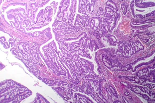 结肠癌影像学表现结肠癌恶性腺细胞特征的研究 — 图库照片