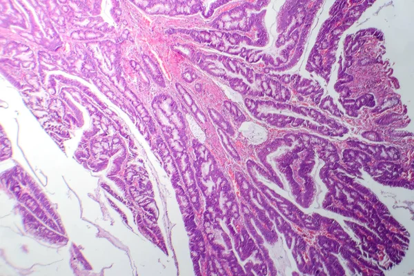 結腸癌の特徴を示す悪性腺細胞を示す大腸腺癌の写真グラフ — ストック写真
