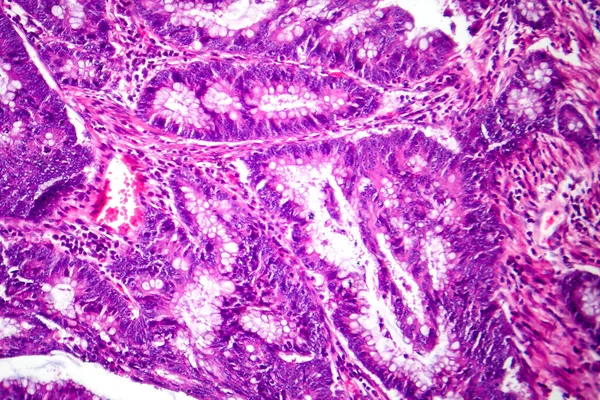 Photomicrograph of colon adenocarcinoma, illustrating malignant glandular cells characteristic of colon cancer.