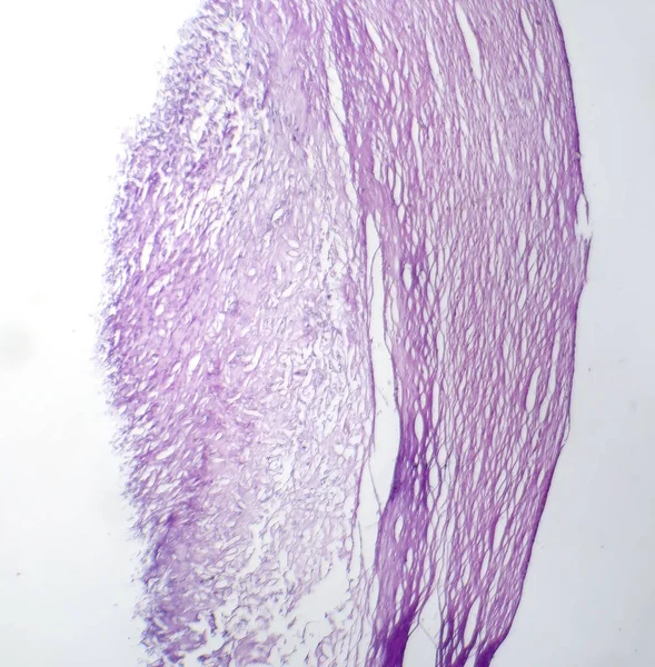 Fotomicrografia Melanoma Mostrando Melanócitos Malignos Células Primárias Responsáveis Pelo Câncer — Fotografia de Stock