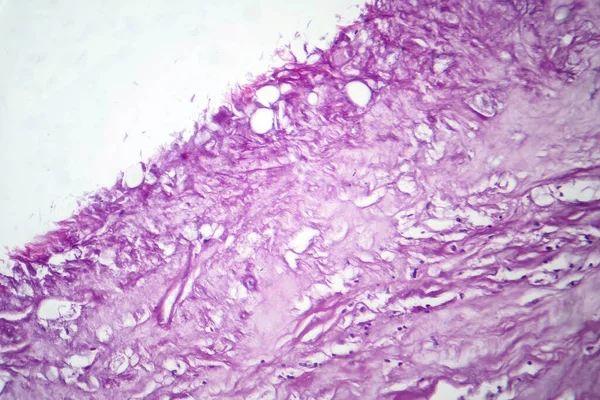 Fotomikrograf Melanomu Zobrazující Maligní Melanocyty Primární Buňky Zodpovědné Agresivní Rakovinu — Stock fotografie