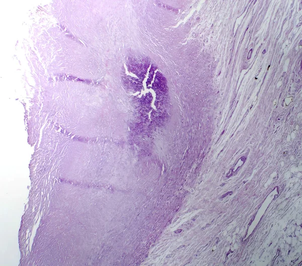主动脉粥样硬化的显微照片 揭示胆固醇沉积引起的斑块堆积和主动脉狭窄 — 图库照片
