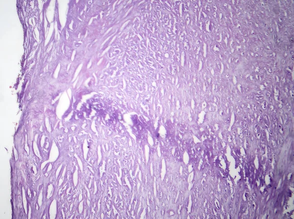 Fotomikrografi Aortaateroskleros Avslöjar Plack Uppbyggd Och Förträngning Aortan Grund Kolesterolavlagringar — Stockfoto