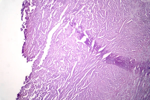 Fotomicrografía Aterosclerosis Aórtica Revelando Acumulación Placa Estrechamiento Aorta Debido Depósitos — Foto de Stock