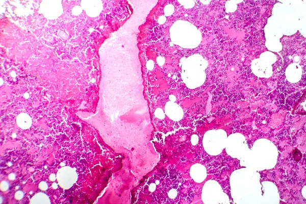 Fotomicrografia Pneumonia Lobar Durante Período Edema Hemorrágico Exibindo Inflamação Tecido — Fotografia de Stock