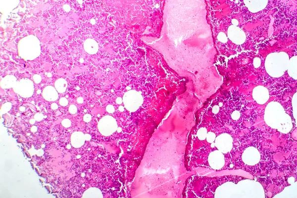 Φωτομικρογραφία Της Πνευμονίας Του Λοβού Κατά Διάρκεια Της Περιόδου Αιμορραγικού — Φωτογραφία Αρχείου