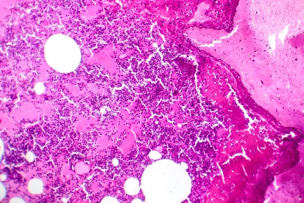 Photomicrographie Pneumonie Lobaire Pendant Période Œdème Hémorragique Montrant Une Inflammation — Photo