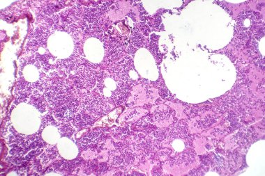 Kanamalı ödem döneminde lobar zatürreenin fotomikrografı akciğer dokusunda kanamalı değişimler gösteriyor..