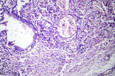 Viral zatürreenin fotomikrografı viral solunum enfeksiyonundan kaynaklanan iltihaplanma ve hücresel hasarı ortaya çıkarıyor..