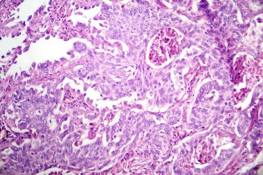 Akciğer adenokarsinomunun fotomikrografı, en yaygın akciğer kanserinin karakteristik kötü huylu salgı hücrelerini gösteriyor..