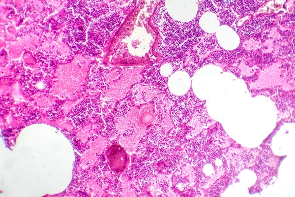 出血性水肿期小叶性肺炎影像学表现为肺组织炎症及出血性变化 — 图库照片