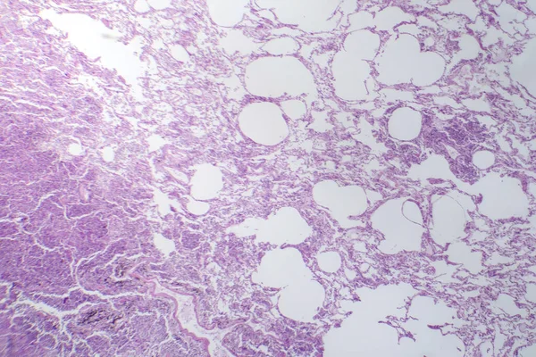 Photomicrograph Interstitial Pneumonia Showing Inflammation Fibrosis Lung Interstitial Tissue — Stock Photo, Image