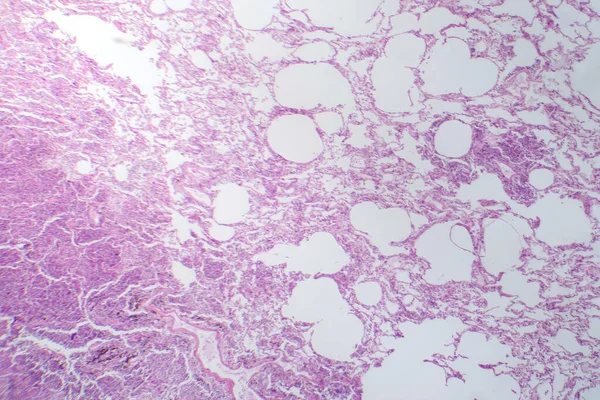 Fotomicrografia Della Polmonite Interstiziale Che Mostra Infiammazione Fibrosi Nel Tessuto — Foto Stock