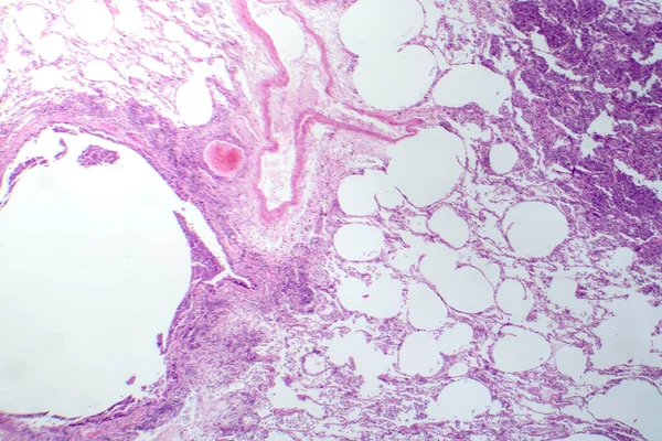 Photomicrographie Pneumonie Interstitielle Montrant Une Inflammation Une Fibrose Tissu Interstitiel — Photo