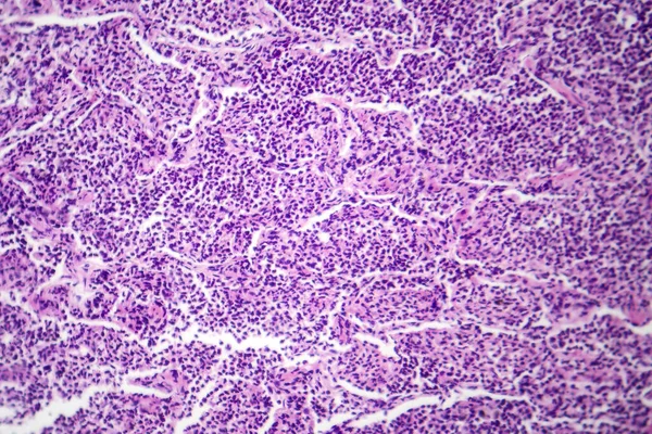 Interstitial 조직에 그리고 섬유증을 보여주는 Interstitial 폐렴의 Photomicrograph — 스톡 사진