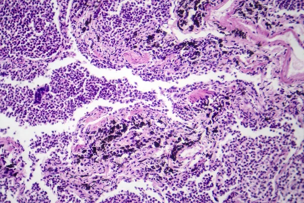 Fotomicrografia Della Polmonite Interstiziale Che Mostra Infiammazione Fibrosi Nel Tessuto — Foto Stock