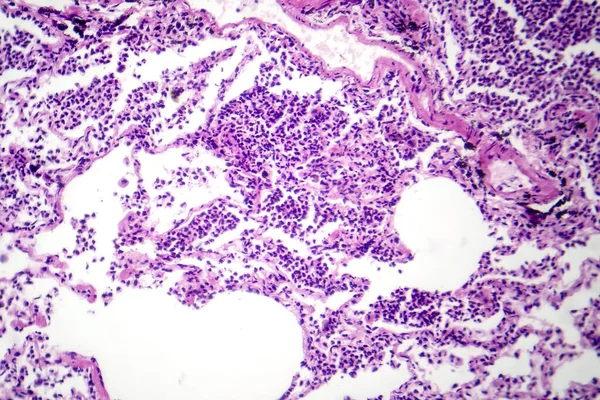 Photomicrograph Interstitial Pneumonia Showing Inflammation Fibrosis Lung Interstitial Tissue — Stock Photo, Image
