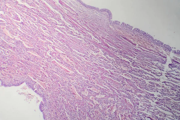 Fotomikrograf Virové Pneumonie Odhalující Zánět Buněčné Poškození Způsobené Virovou Respirační — Stock fotografie