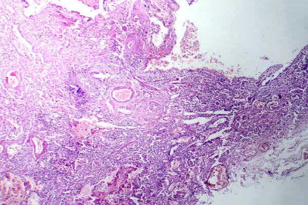 Viral Zatürreenin Fotomikrografı Viral Solunum Enfeksiyonundan Kaynaklanan Iltihaplanma Hücresel Hasarı — Stok fotoğraf