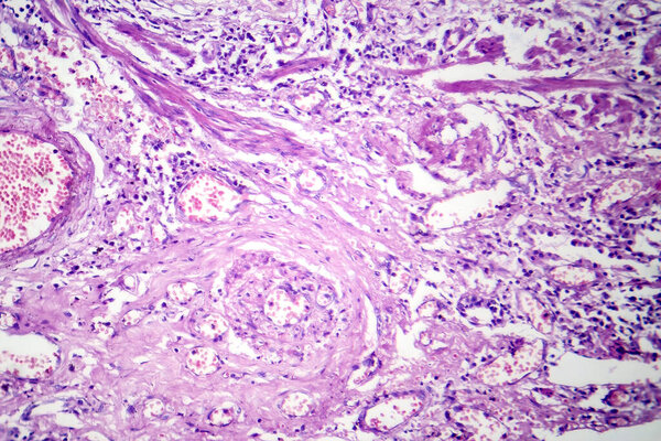 Фотомикрограф вирусной пневмонии, показывающий воспаление и клеточные повреждения, вызванные вирусной респираторной инфекцией.