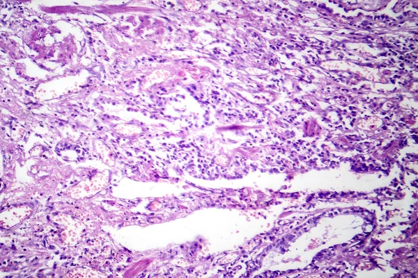 Fotomikrografi Viral Pneumoni Avslöjar Inflammation Och Cellskador Orsakade Virusinfektion Luftvägarna — Stockfoto