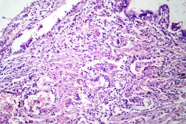 Photomicrograph Viral Pneumonia Revealing Inflammation Cellular Damage Caused Viral Respiratory — Stock Photo, Image