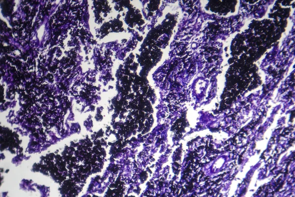 Photomicrograph of silicosis, revealing lung tissue scarring and inflammation caused by inhaling crystalline silica particles.