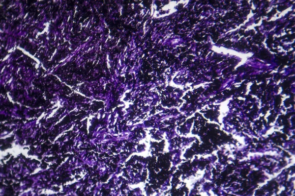 Fotomicrograma Silicosis Revelando Cicatrices Tejido Pulmonar Inflamación Causada Por Inhalación — Foto de Stock