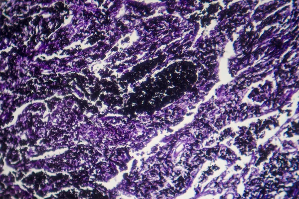 Photomicrograph of silicosis, revealing lung tissue scarring and inflammation caused by inhaling crystalline silica particles.