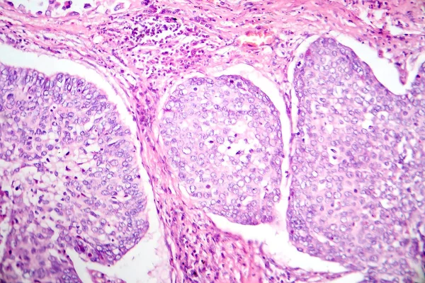 肺腺癌的显微照片 显示最常见类型肺癌的恶性腺细胞特征 — 图库照片