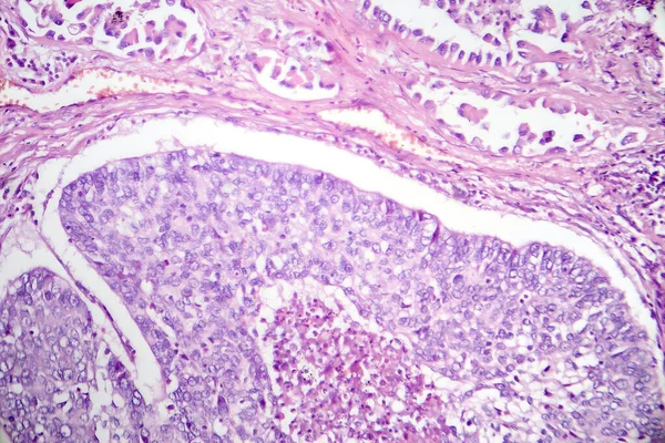 Photomicrograph of lung adenocarcinoma, illustrating malignant glandular cells characteristic of the most common type of lung cancer.