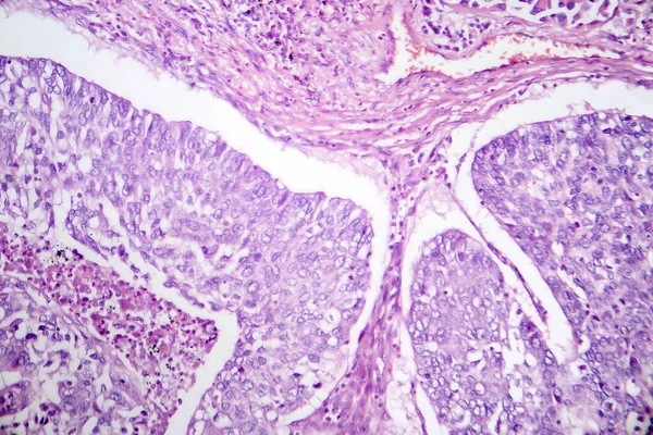 肺がんの最も一般的なタイプの悪性腺細胞の特徴を示す肺腺がんの写真グラフ — ストック写真