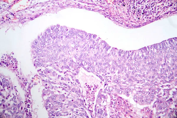 Fotomicrografia Adenocarcinoma Pulmonar Ilustrando Células Glandulares Malignas Características Tipo Mais — Fotografia de Stock